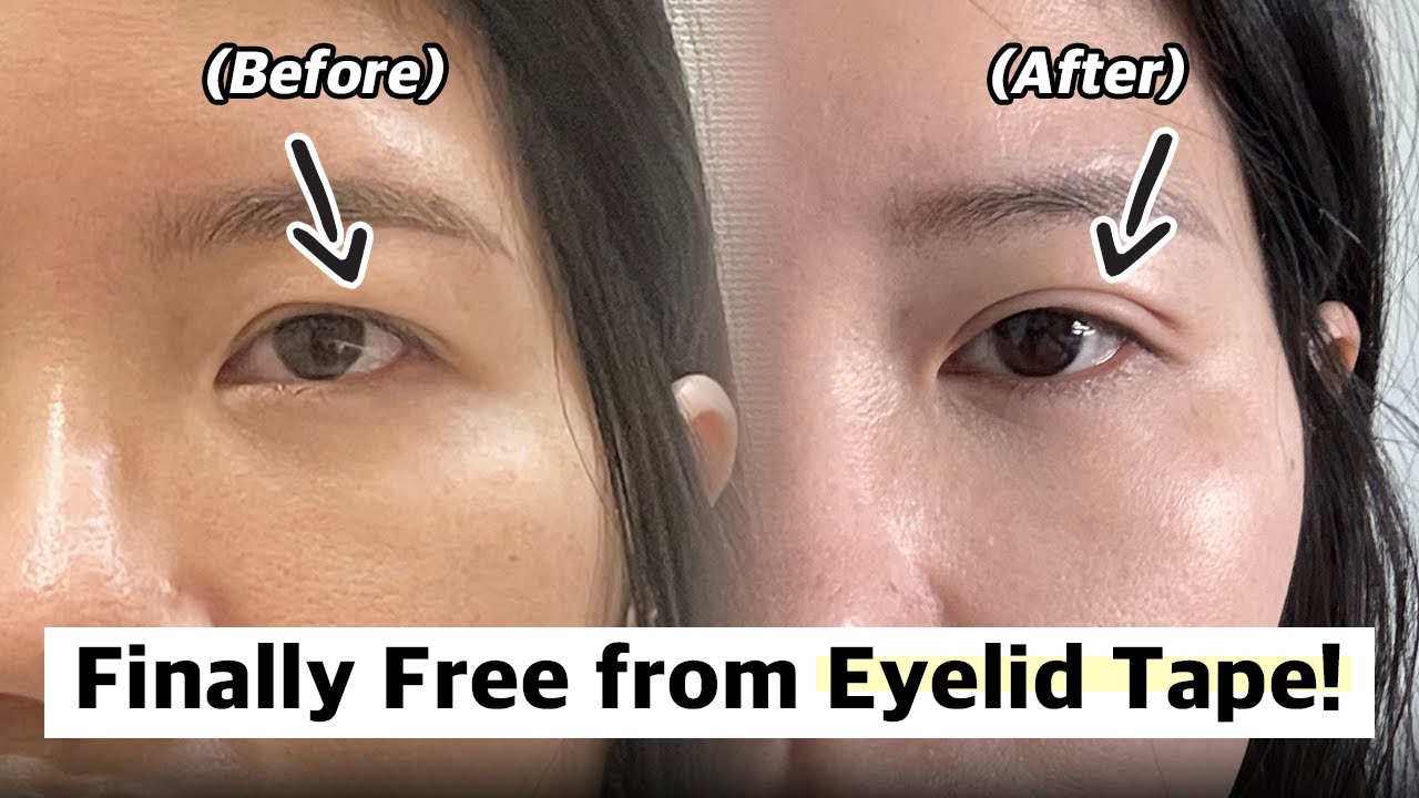 Eyelid transformation from droopy to dreamy NANA Plastic Surgery Korea YouTube video