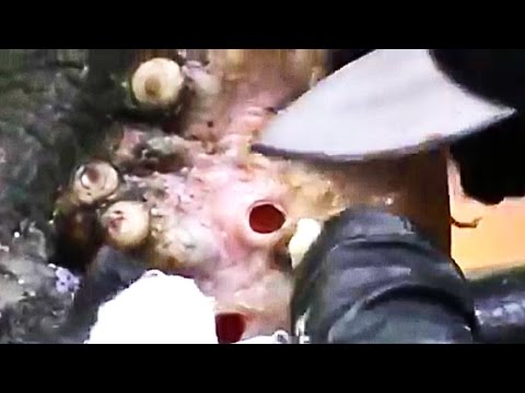 Gimnastyka w ploskovalgusnoy deformacjami stóp Leczenie kości na kciuk w domu