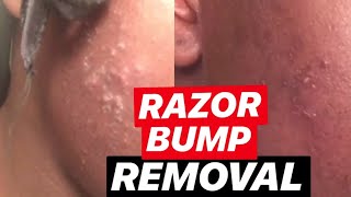 How To Get Rid Of Razor Bumps | Tutorial
