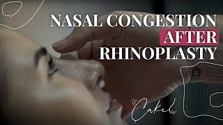 Nasal congestion after rhinoplasty - Dr Tolga Çakıl (27.06.2024)