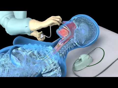 Nasotracheal suctioning (NTS) - 3D animation