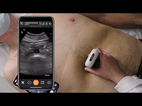 Scanning the Abdominal Aorta