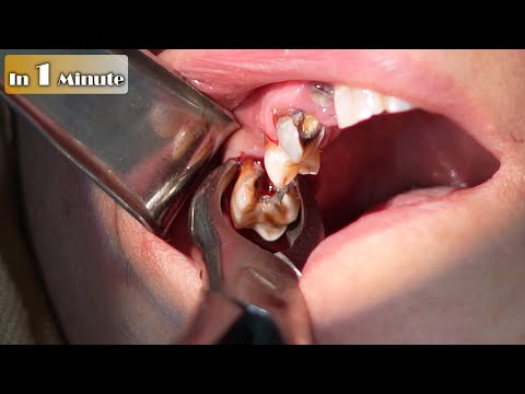 Removed Tooth In 1 Minute | Molar Tooth Extraction