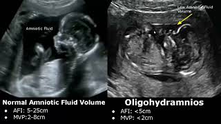 Amniotic Fluid Volume Ultrasound Normal Vs Abnormal | Oligohydramnios/Polyhydramnios | AFP/MVP USG