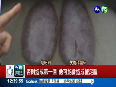 赴陸拔罐治痠痛 婦人背灼傷潰爛