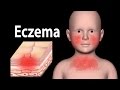Eczema, Animation.