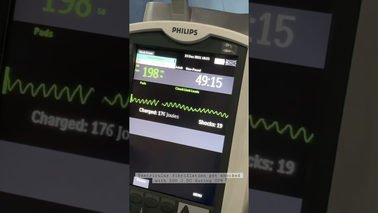 Ventricullar fibrillation got shocked with 200 J DC during CPR #cardiology #icu #criticalcare #cpr