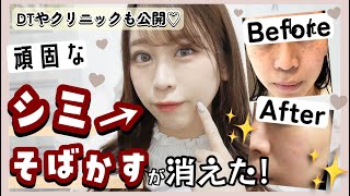 【頑固なシミ・そばかすが消えた⁈】費用や経過も全て公開✨