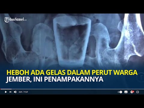 HEBOH Ada Gelas dalam Perut Warga Jember, Asal Muasal Masih Misterius, Begini Penampakannya