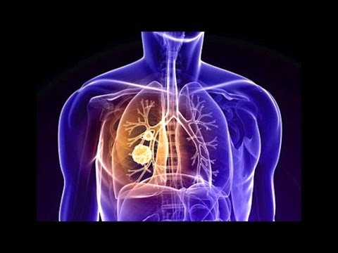 Midollo spinale grave dolore che è Farmaci per il trattamento della sindrome dellarteria cervicale