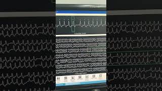 Download lagu Holter Monitoring | Intermittent Atrial Fibrillation|  #cardiology #cardiacrehab mp3