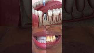 Dental Implants in Turkey | Step-by-Step Procedure