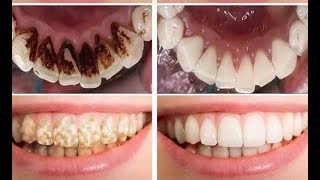 Get Rid of Smoking stains and Tobacco stains from Teeth FAST.