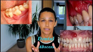 How to treat a Dental Abscess (Different Natural Mouthrinses and their uses)