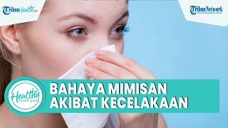 Bahaya Mimisan akibat Kecelakaan Picu Cedera Kepala, Simak Ulasan dr Dwi Septiadi
