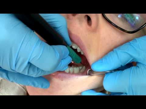 Prophylaxis Tips with the Ultrasonic