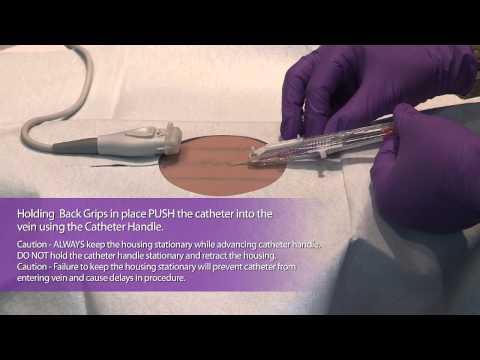 PowerGlide Midline Catheter - MDEA 2013 Bronze Winner