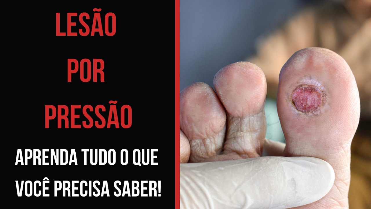 LESÃO POR PRESSÃO: APRENDA TUDO O QUE VOCÊ PRECISA SABER