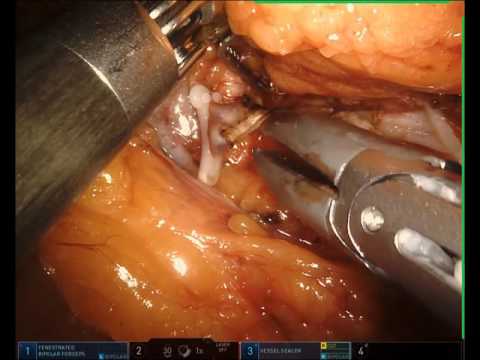 Robotic Left Donor Nephrectomy