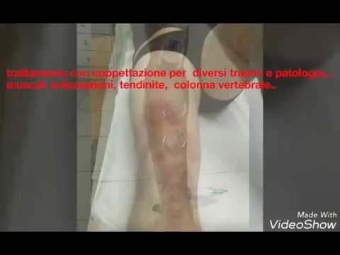 Come trattare il mal di schiena nella parte bassa della schiena, se Come trattare i farmaci osteocondrosi toraciche