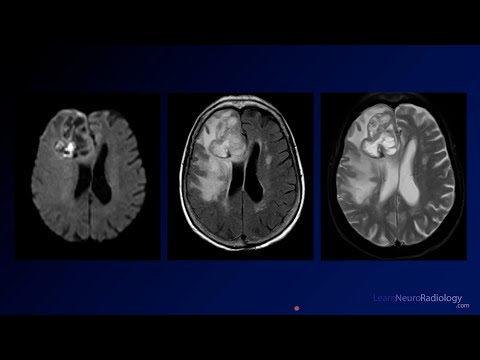 Neuroradiology Board Review - Brain Tumors - Case 1
