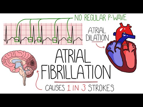 Atrial Fibrillation Made Easy (Complete Overview)