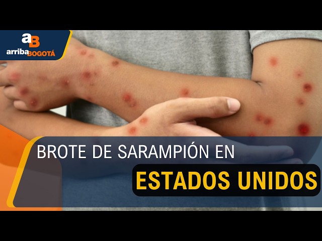 Brote de sarampión en Estados Unidos: casos podrían duplicarse al cierre de 2026