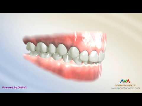 Orthodontic Treatment for Deepbite - Cantilever Wire