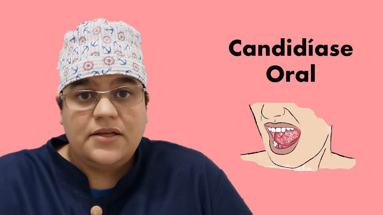 Candidíase Oral o que é e como tratar | Dra Bianca Rosa