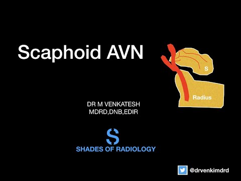 TUTE 6- Scaphoid fracture and  AVN