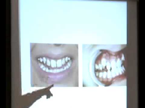 Dr. James Beck Fluoride Discussion