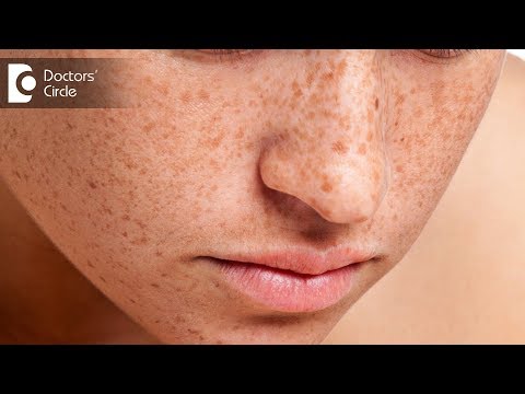 How to get rid of freckles on face? - Dr. Swetha Sunny...