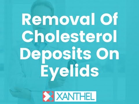 Removal Of Cholesterol Deposits On Eyelids