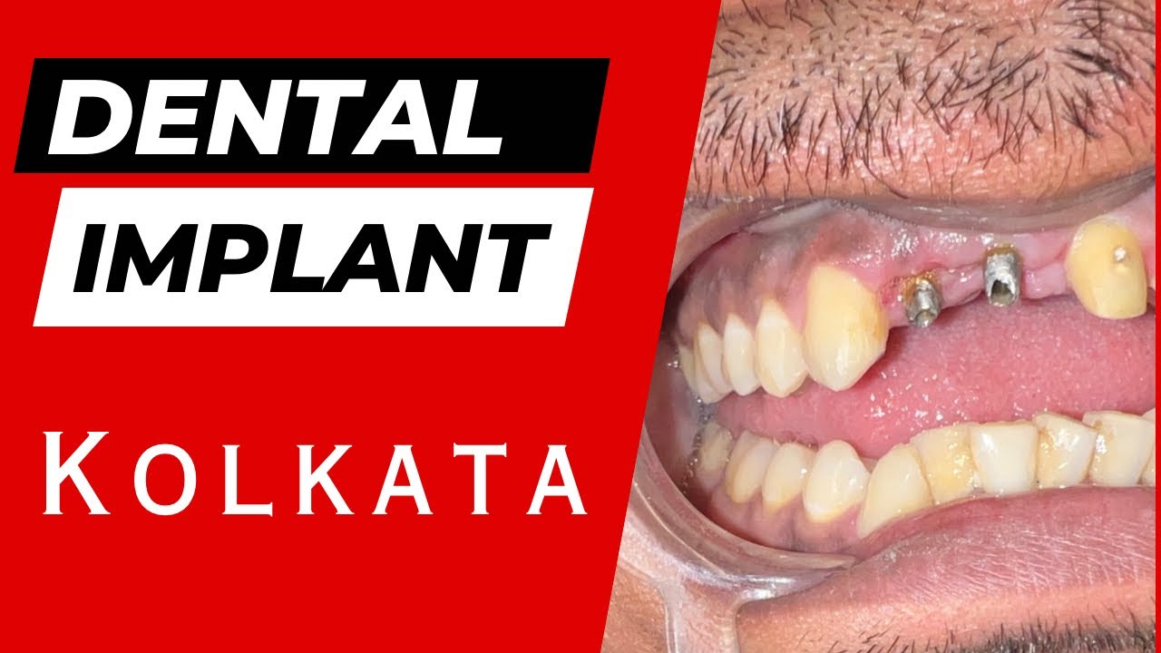 Top Dental Implant Clinic in Kolkata | Best Dental Implant Center Kolkata