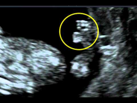 Fetal Medicine Foundation - Short Rib Polydactyly Syndrome
