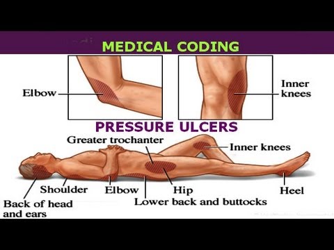 Medical Coding for Pressure Ulcers