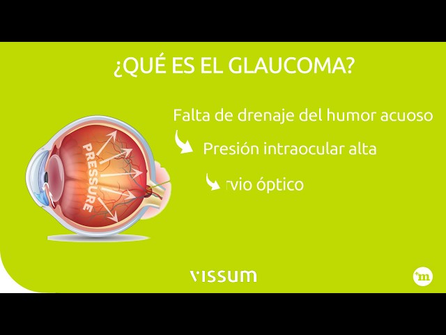 Glaucoma. Causas y tratamiento - Vissum Madrid