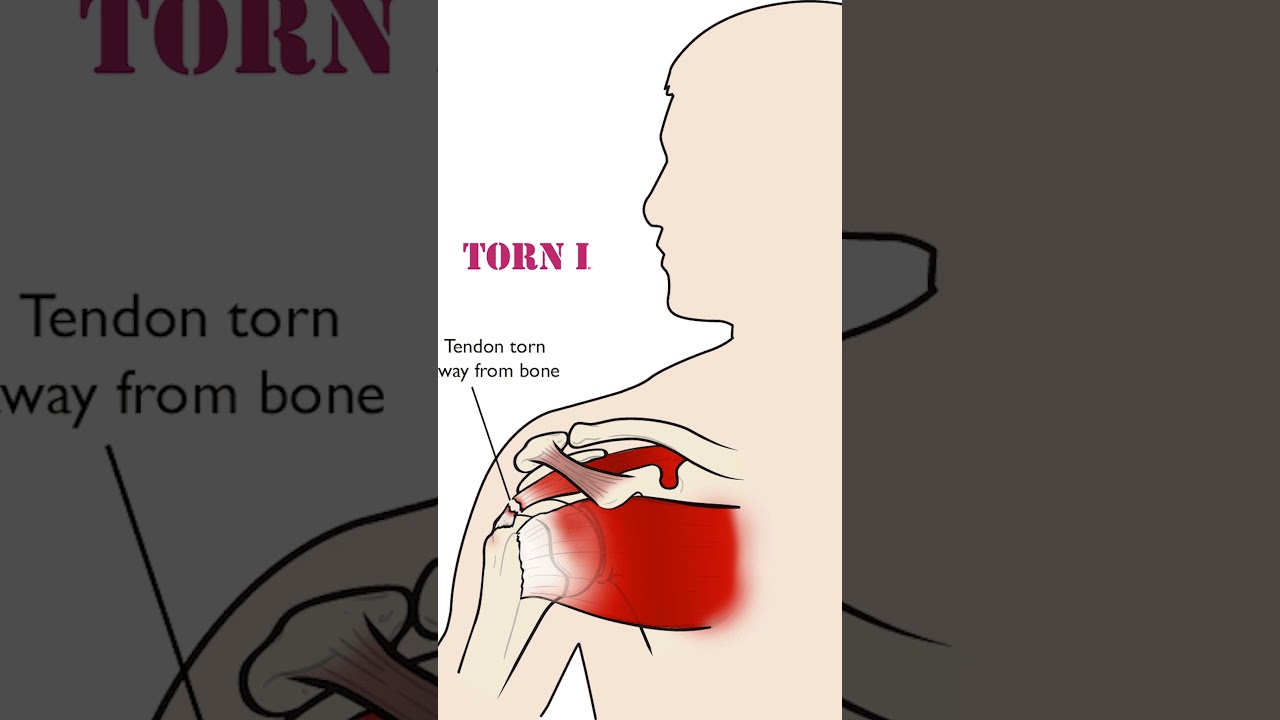 What Is A Separated Shoulder? | Treatments for Orthopedic Disease | Best Stem Cell Center In India