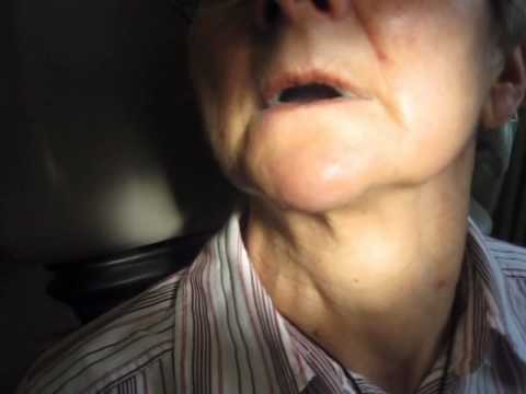 Simplified Speech Therapy- Interiorized Imitation