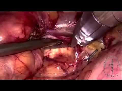 Laparoscopic Radical Nephrectomy - Ureter ligation