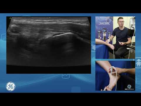 Ultrasound guided ankle and subtalar joint injection technique for POCUS clinicians