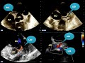 Tips and tricks: Direct Coronary Visualization with Transthoracic Echo