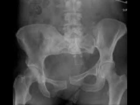 Podcast 692: Pelvic Fractures