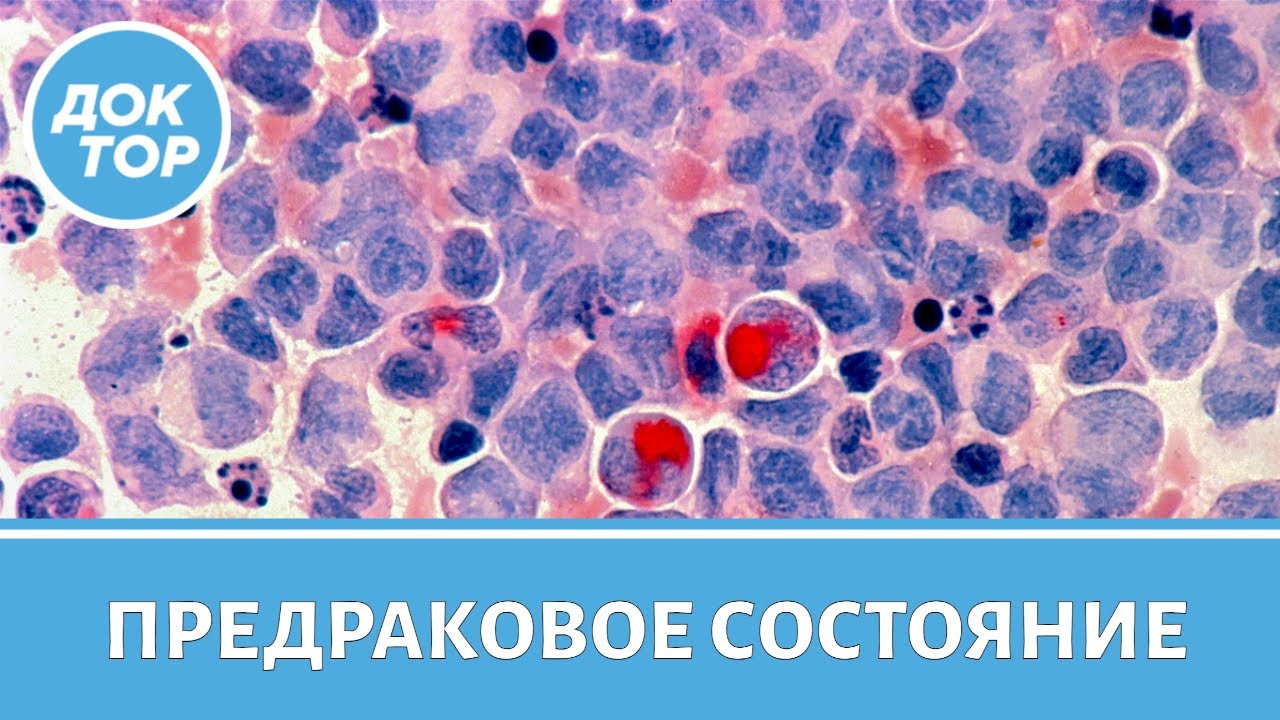 Что такое миелодиспластический синдром