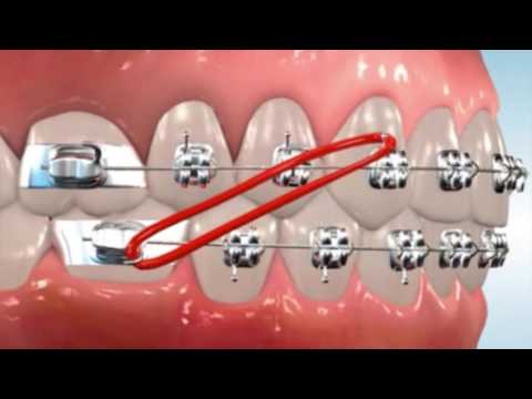 Class 2 Elastics - Easton Ortho 101 with Dr. Loftus