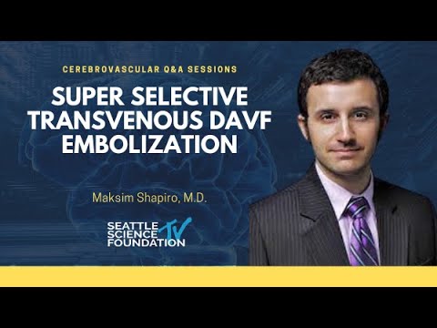Super Selective Transvenous dAVF Embolization  –  Maksim Shapiro, M.D.