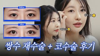 쌍수 재수술 + 매부리코 수술 전후 후기 l 재수술 실패하지 않는 방법  윌비 성형외과