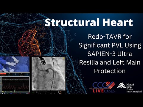Redo-TAVR for Significant PVL Using SAPIEN-3 Ultra Resilia and Left Main Protection