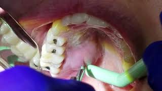 Tooth abscess drained in the mouth