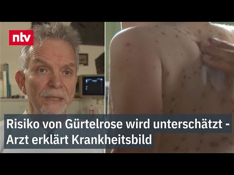 Umfrage ergibt: Risiko von Gürtelrose wird unterschätzt - Arzt erklärt Krankheitsbild